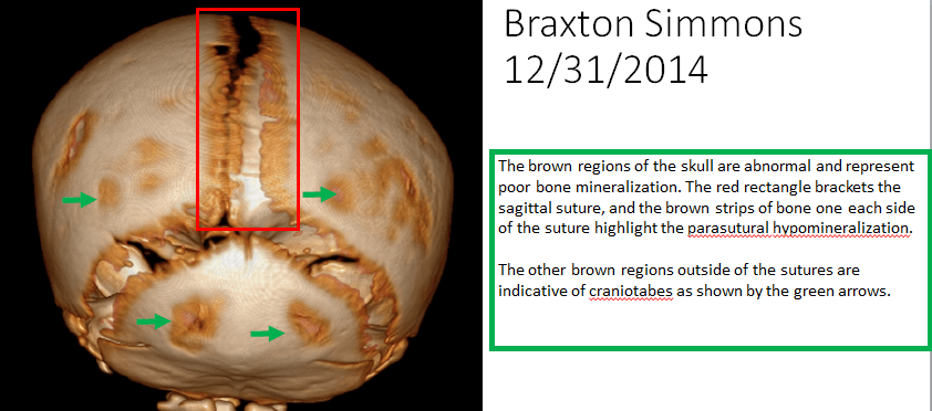 Braxton's skull