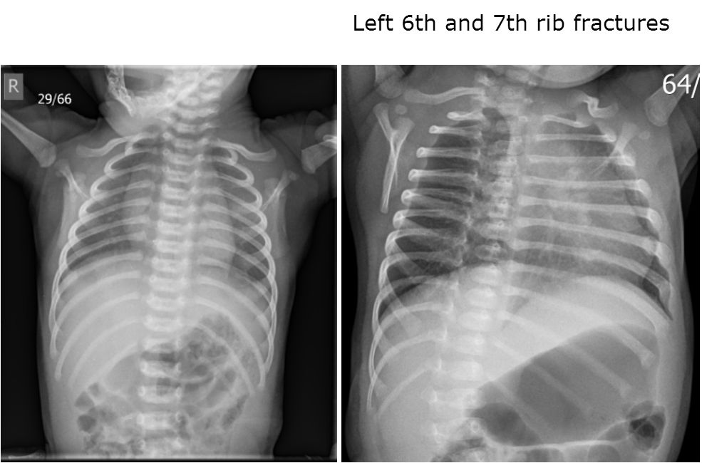 South Carolina Baby with Metabolic Bone Disorder Medically Kidnapped ...