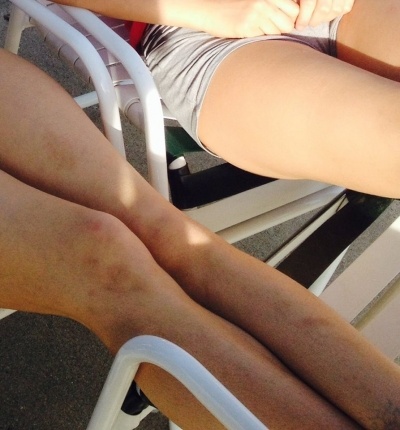 Odonnell Alexis bruised legs from Wolverine