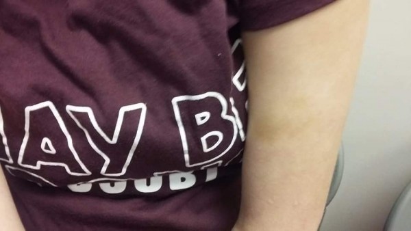 Searcy bruise on arm
